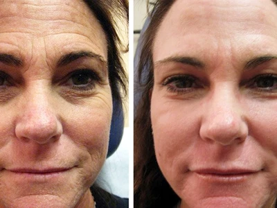 ¿Puede Laser deshacerse de la piel suelta?