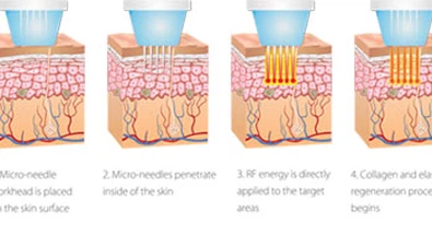 ¿Es la RF fraccionada segura para todo tipo de piel?