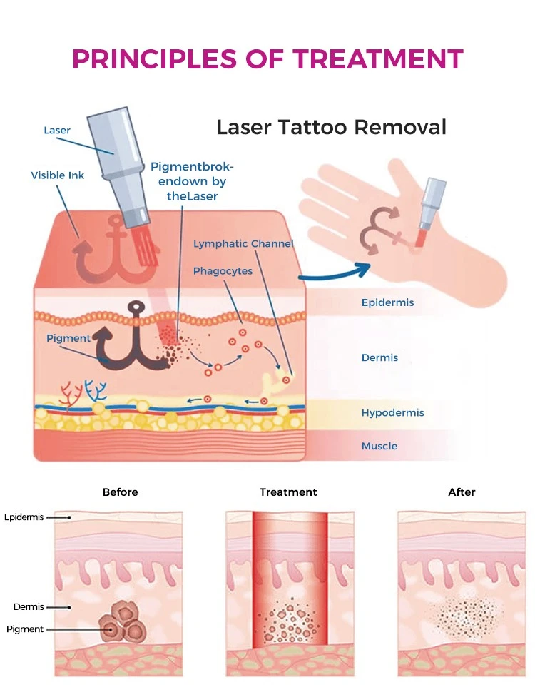 Q-switched Nd Yag laser machine for tattoo removal Q-switched Nd Yag laser machine for tattoo removal